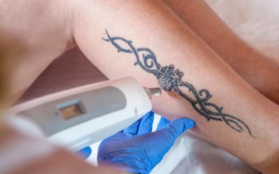A woman is having laser tattoo removal on her leg.