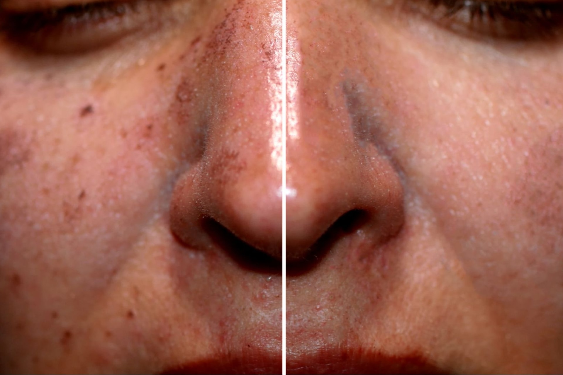 sun damaged skin before and after laser treatment