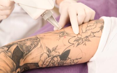 best-laser-for-tattoo-removal