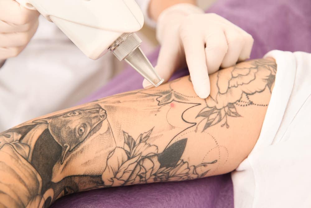 best-laser-for-tattoo-removal