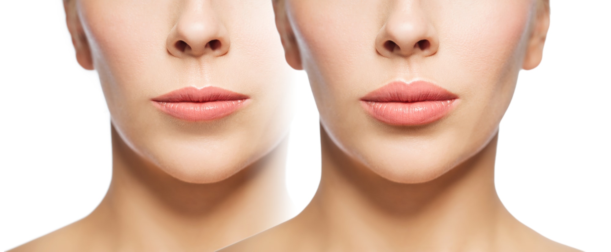 Before and after pictures of a woman who had laser lip treatment.