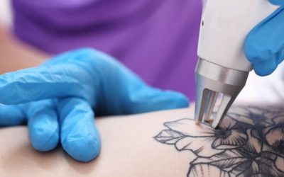 A customer is having a tattoo removed by a laser.
