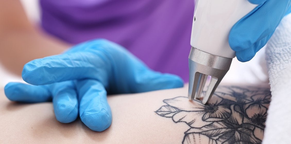 A customer is having a tattoo removed by a laser.