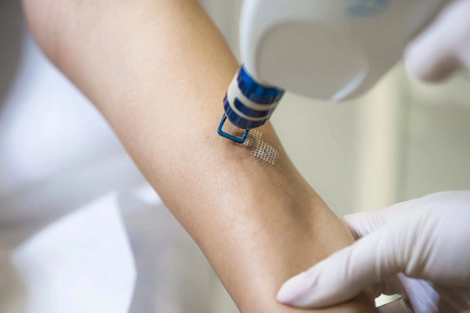 laser therapy downtime