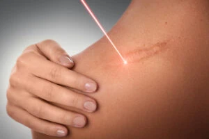 laser therapy for scars
