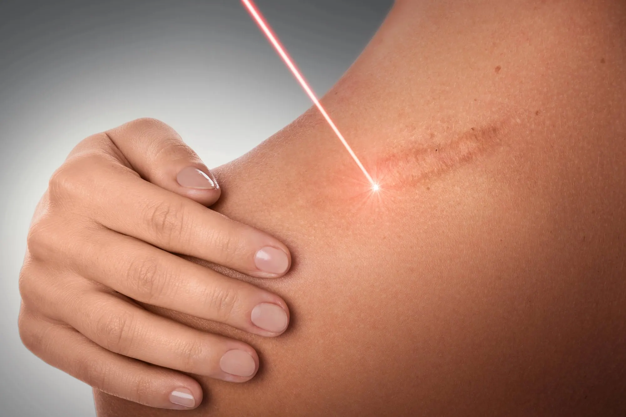 laser therapy for scars