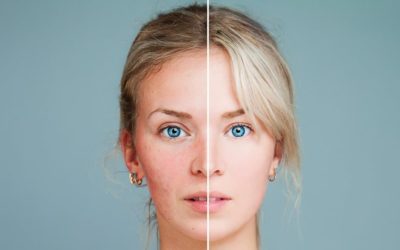 best laser for rosacea
