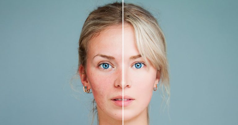 best laser for rosacea