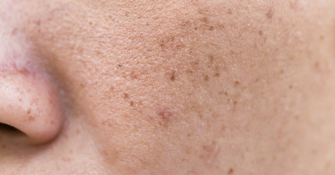 An up-close view of a person's skin with imperfections.