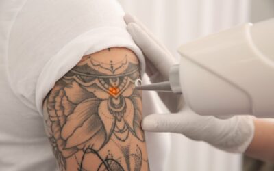 Summer: Why You Should Advise Clients to Wait for Tattoo Removal 