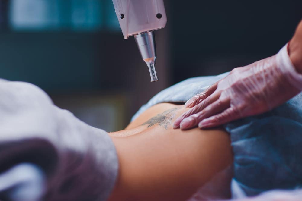 what-is-the-best-laser-for-tattoo-removal
