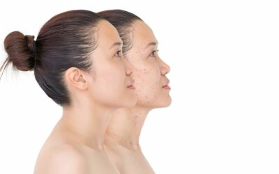 advantages of yag laser for acne treatment