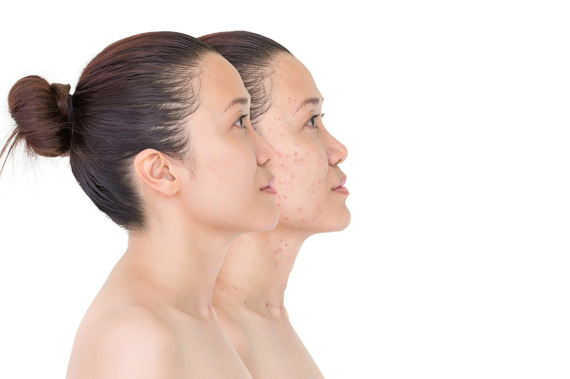 advantages of yag laser for acne treatment